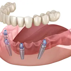 Implanty zębów cała szczęka cena. Widok implantów stomatologicznych w szczęce, gotowych do zamocowania protezy.