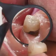 Widok z lusterka dentystycznego na ząb z widoczną koroną kompozytową, która chroni go przed dalszym uszkodzeniem.