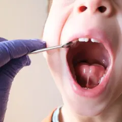 Lekarz w rękawiczce bada wędzidełko języka u dziecka. Czy podcięcie wędzidełka boli? To pytanie nurtuje wielu rodziców.