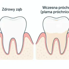 Zdrowy ząb obok zęba z wczesną próchnicą, która zaczyna tworzyć małą dziurę.