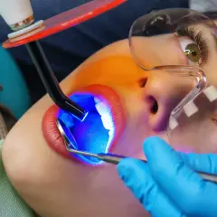 Zabieg lakowania zębów u dorosłych. Dentysta utwardza światłem lampy materiał na zębach.