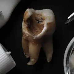 Widok z bliska na zniszczony ząb, pokazujący, jak wygląda próchnica. Obok szczoteczka, pasta i pęseta.