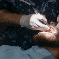 Dentysta usuwa próchnicę, wykonując fleczer w zębie pacjenta.