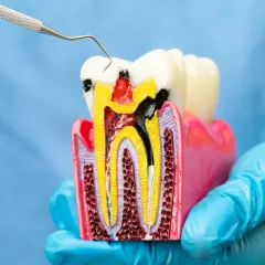 Model zęba pokazuje, co to endodoncja: leczenie kanałowe zniszczonej miazgi.