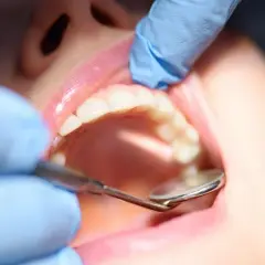 Dentysta bada zęby, szukając oznak próchnicy wtórnej.