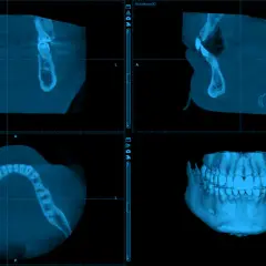 Trzy obrazy tomograficzne żuchwy: przekrój czołowy, boczny i osiowy, oraz trójwymiarowy model szczęki. Rak żuchwy zdjęcia diagnostyczne.