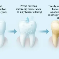 Proces powstawania kamienia nazębnego: od czystego zęba, przez płytkę nazębną mieszającą się z minerałami, aż do twardego, żółtawego kamienia nazębnego.