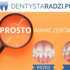 Licówki na krzywe zęby: przed i po. Proste rozwiązanie dla idealnego uśmiechu.