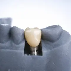 Model szczęki z implantem zębowym. Zastanawiasz się, ile kosztuje implant zęba 6? To inwestycja w Twój uśmiech.