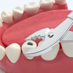 Zastanawiasz się, ile kosztuje wyrwanie zęba? Widok kleszczy dentystycznych przygotowanych do ekstrakcji zepsutego zęba.