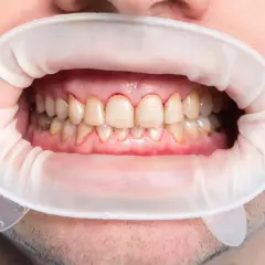 Usta z rozwierakiem dentystycznym, widoczne zęby z przebarwieniami i zaczerwienionymi dziąsłami, sugerujące próchnicę początkową.