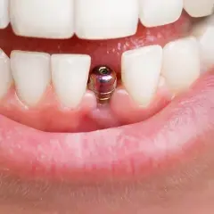 Implant zęba przed i po: metalowy filar wystaje z dziąsła, czekając na koronę.