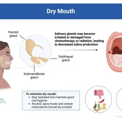 Ilustracja pokazuje gruczoły ślinowe i otwarte usta, wyjaśniając, jak leczenie może powodować suchość w ustach. Zaleca nawodnienie i unikanie alkoholu.