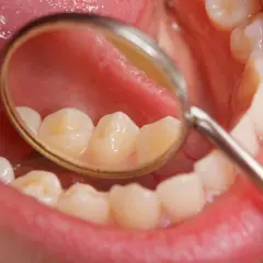 Widok jamy ustnej z lusterkiem dentystycznym. Na zębach widoczne przebarwienia, mogące świadczyć o fluoroza.