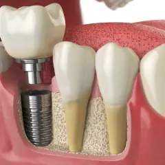 Przekrój przez szczękę pokazujący implant zęba, jego śrubę w kości i koronę. Zastanawiasz się, ile kosztuje implant zęba?