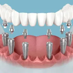 Zęby w jeden dzień cennik: wizualizacja implantów stomatologicznych i protezy górnej szczęki.