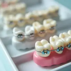 Modele zębów z aparatami ortodontycznymi. Dostępne są różne rodzaje, w tym aparat ortodontyczny NFZ.