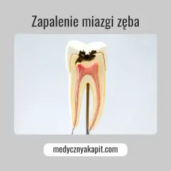 Model zęba z widocznym ubytkiem i zapaleniem miazgi. Objawy zapalenia miazgi mogą być bolesne.