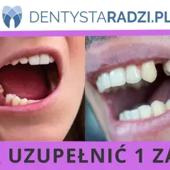Uzupełnienie 1 zęba jedynki na NFZ. Widok otwartych ust z brakującym zębem.
