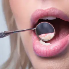 Usta kobiety z lusterkiem dentystycznym badającym zęby, uwidaczniające początki demineralizacji szkliwa.
