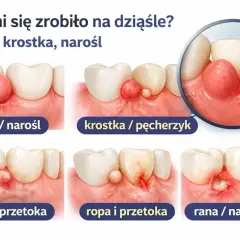 Ilustracja pokazuje różne zmiany na dziąśle: bezbolesny guzek, krostkę, ropień i ranę.