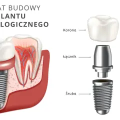 Schemat budowy implantu stomatologicznego: śruba, łącznik, korona. Implant zęba NFZ to rozwiązanie dla pięknego uśmiechu.