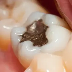 Zbliżenie na ząb z ciemną, metaliczną plombą. Widać też inne zęby i fragment dziąsła.