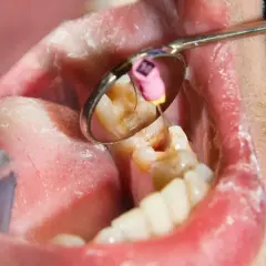 Widok jamy ustnej z lustrem dentystycznym, ukazującym ząb z widocznym stanem zapalnym, sugerującym nieleczony ropień zęba.