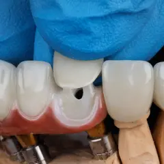 Dłoń w niebieskiej rękawiczce dopasowuje ceramiczną koronę zęba do modelu.
