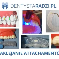 Nakładka silikonowa na zęby z przyklejanymi attachmentami. Proces leczenia ortodontycznego.