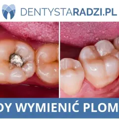 Przed i po leczeniu próchnicy: stary, metalowy wypełnienie zęba zastąpione nowym, estetycznym.