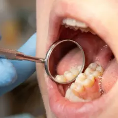 Dentysta bada zęby, szukając próchnicy między zębami. Widać odbicie zębów w lusterku dentystycznym.