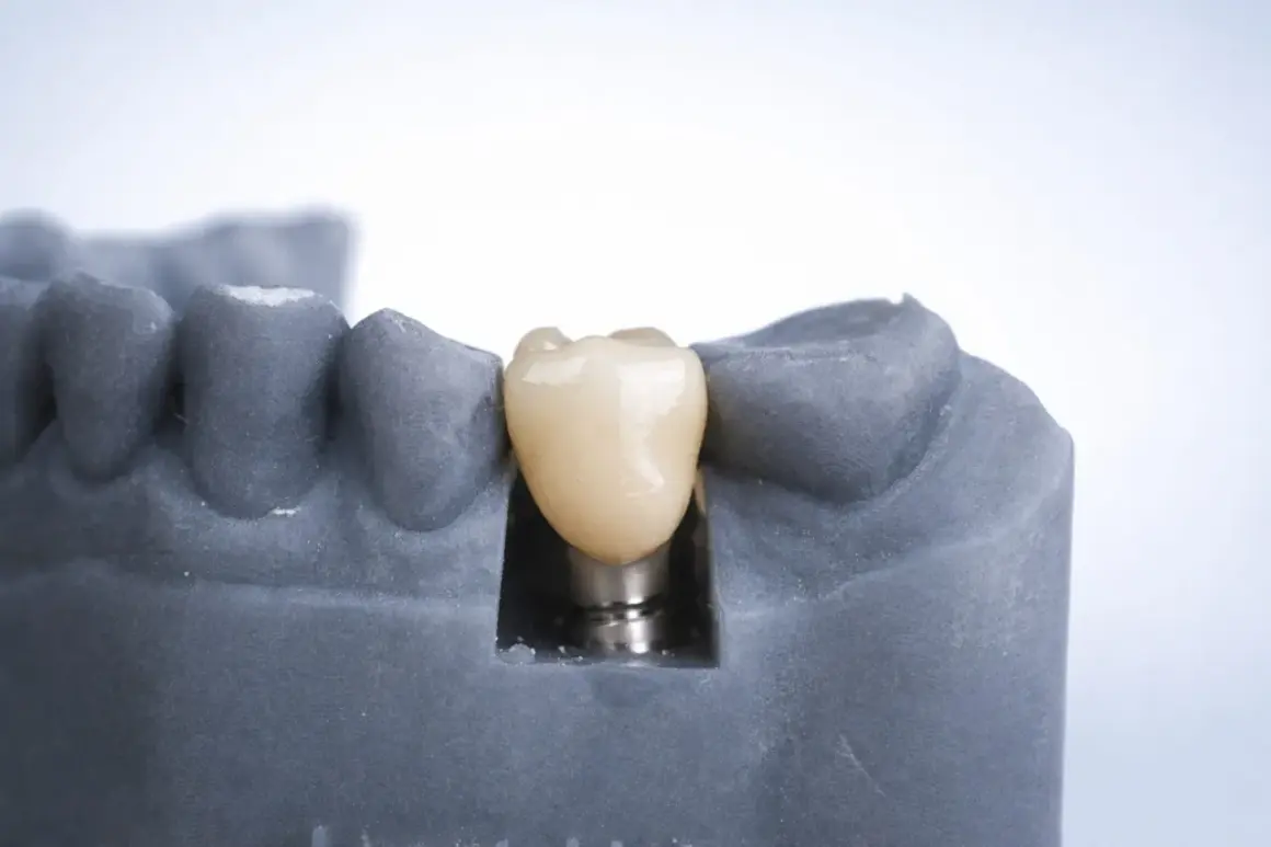 Model szczęki z implantem zębowym. Zastanawiasz się, ile kosztuje implant zęba 6? To inwestycja w Twój uśmiech.