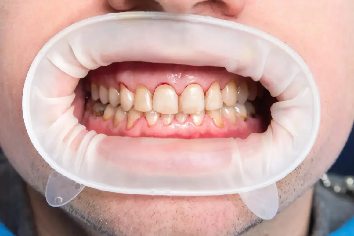 Usta z rozwierakiem dentystycznym, widoczne zęby z przebarwieniami i zaczerwienionymi dziąsłami, sugerujące próchnicę początkową.