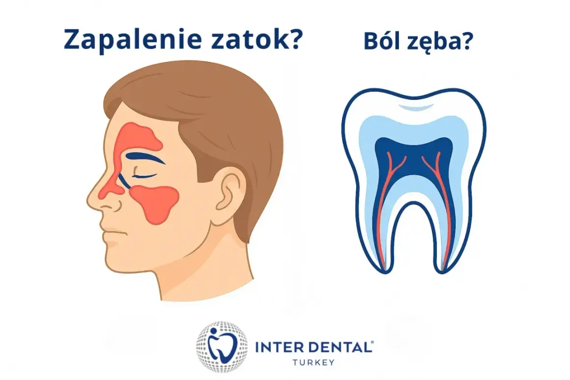 Zapalenie zatok czy ból zęba? Ilustracja pokazuje profil twarzy z zaznaczonymi zatokami oraz przekrój zęba z kanałami.