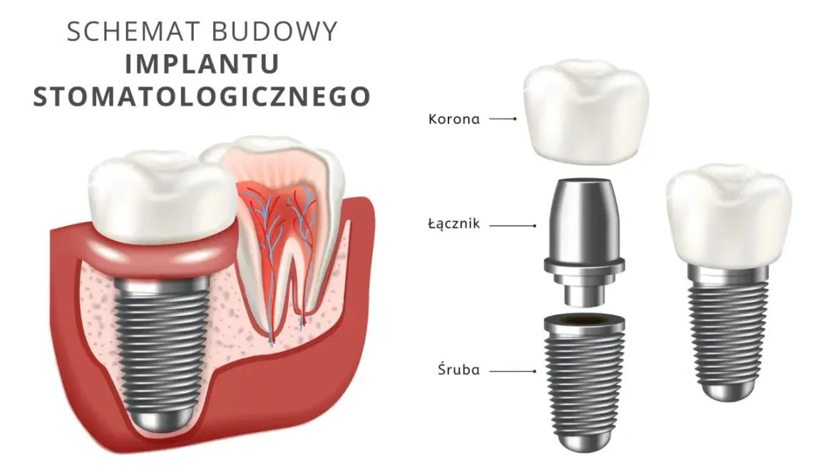 Schemat budowy implantu stomatologicznego: śruba, łącznik, korona. Implant zęba NFZ to rozwiązanie dla pięknego uśmiechu.