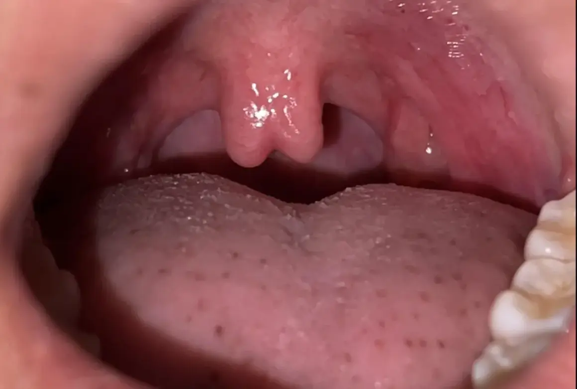 Widok wnętrza jamy ustnej z językiem i widocznym języczkiem podniebiennym.