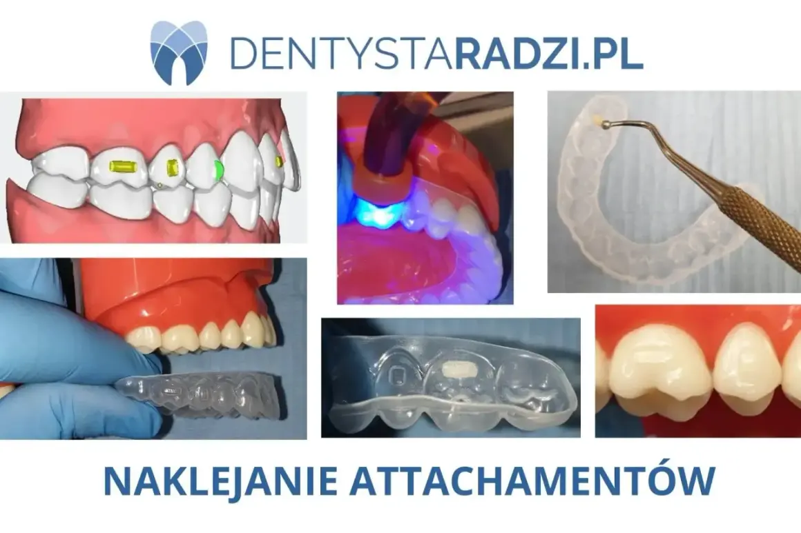 Nakładka silikonowa na zęby z przyklejanymi attachmentami. Proces leczenia ortodontycznego.