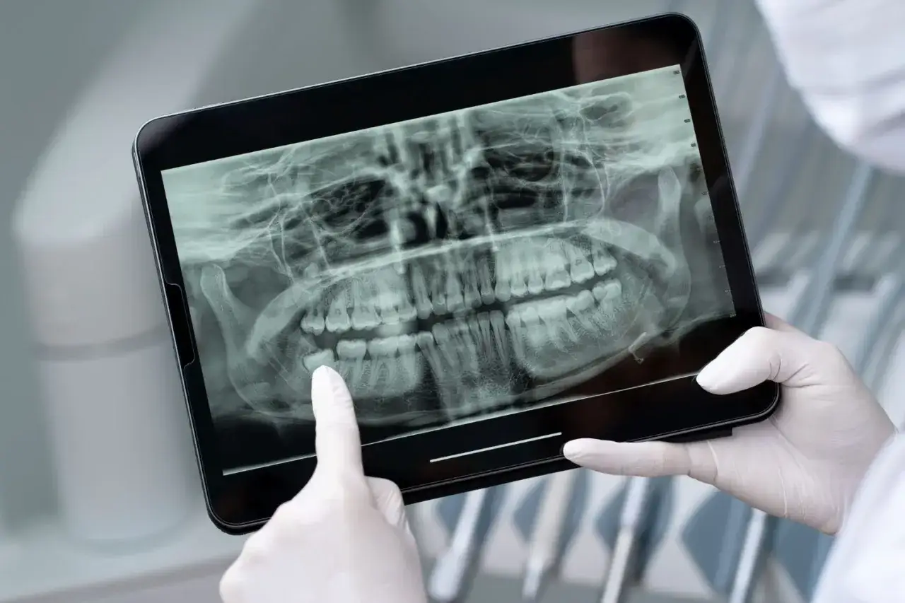 Dentysta analizuje zdjęcie RTG szczęki na tablecie, wskazując na ósemkę. Zastanawia się, ile L4 będzie potrzebne po wyrwaniu.