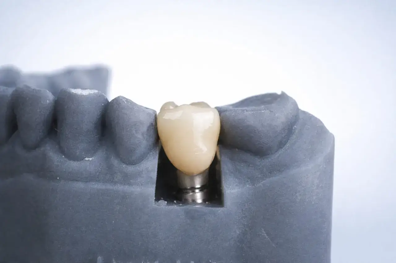 Model szczęki z implantem zębowym. Szukasz najtańszych implantów zębowych w Polsce? Ten model pokazuje, jak może wyglądać Twój nowy, piękny uśmiech.