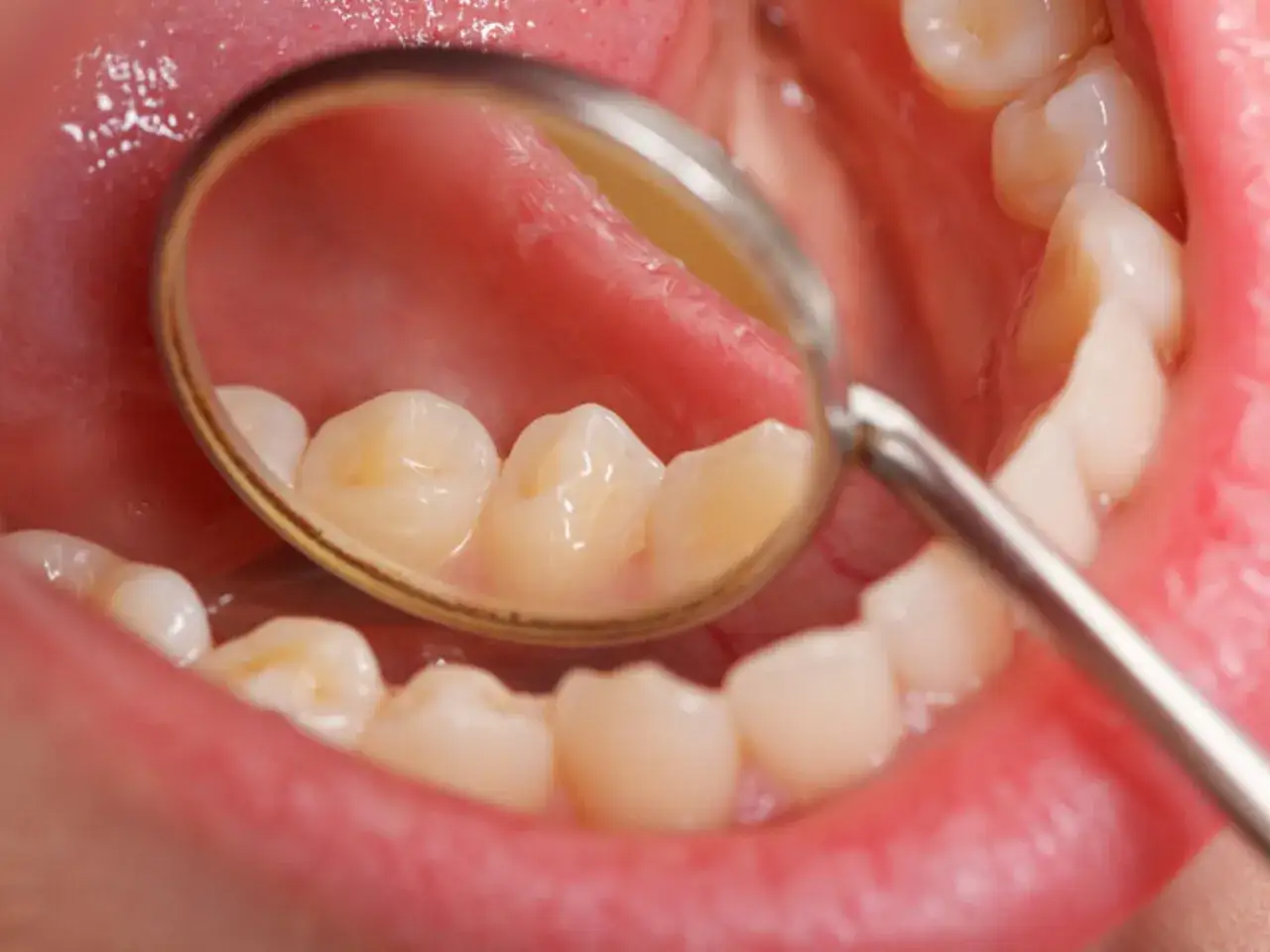 Widok jamy ustnej z widocznymi zębami i lusterkiem dentystycznym. Na zębach widoczne są przebarwienia, mogące świadczyć o próchnicy u dzieci.
