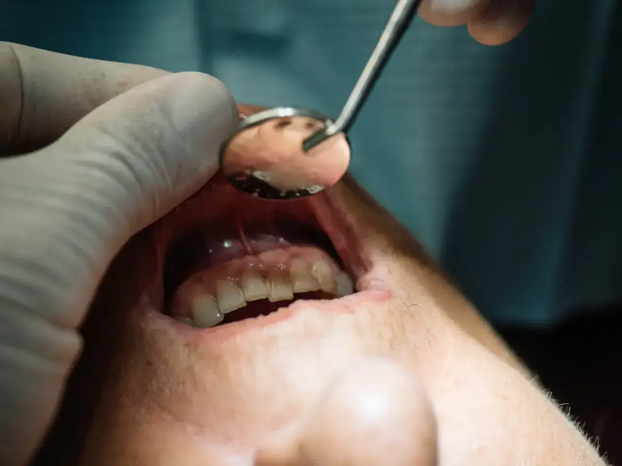 Usta pacjenta z widocznym zaczerwienieniem i obrzękiem dziąsła, sugerującym nieleczony ropień zęba. Dentysta bada jamę ustną lusterkiem.