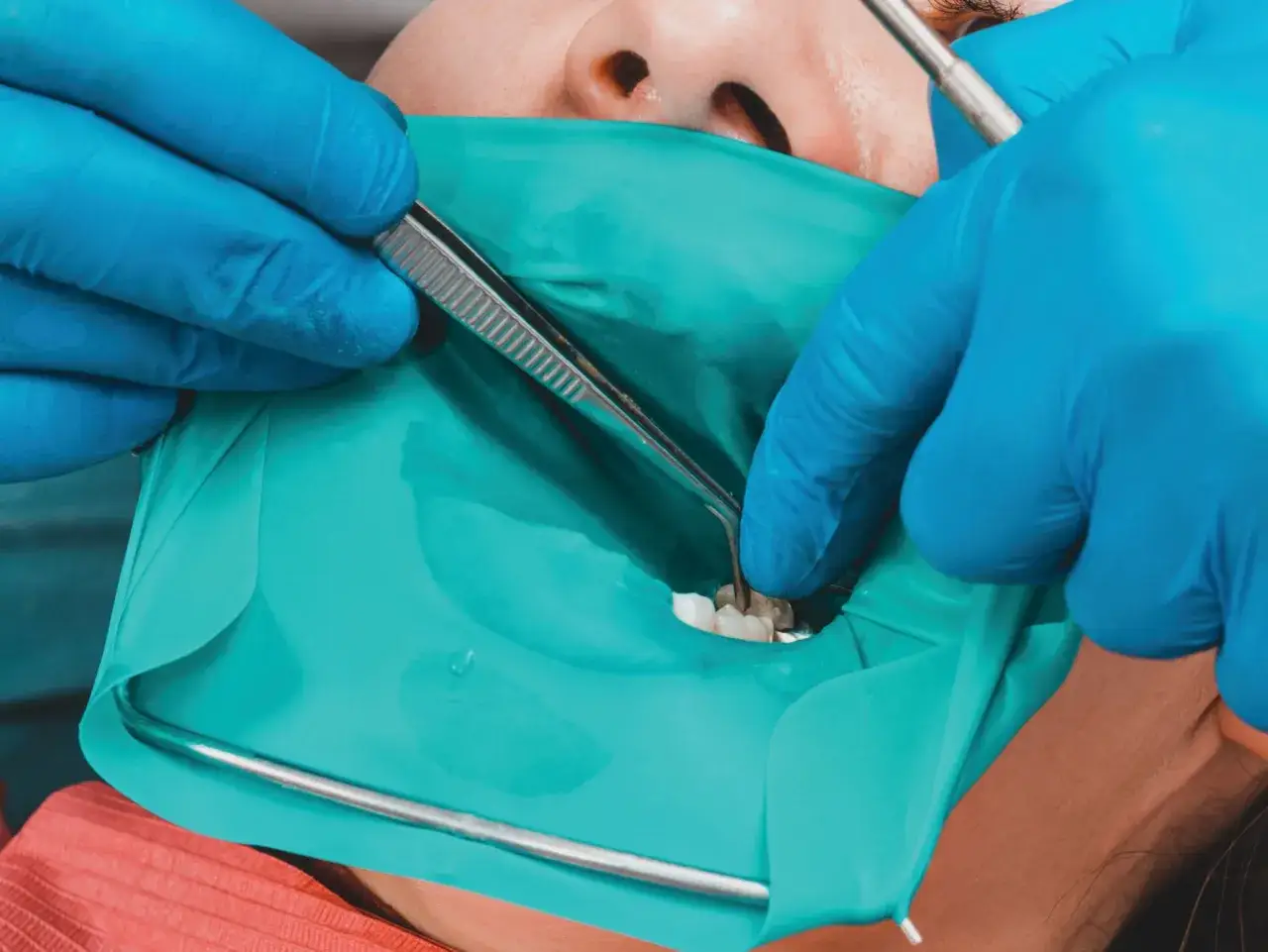 Dentysta zakłada koferdam, izolując zęby pacjenta do zabiegu.
