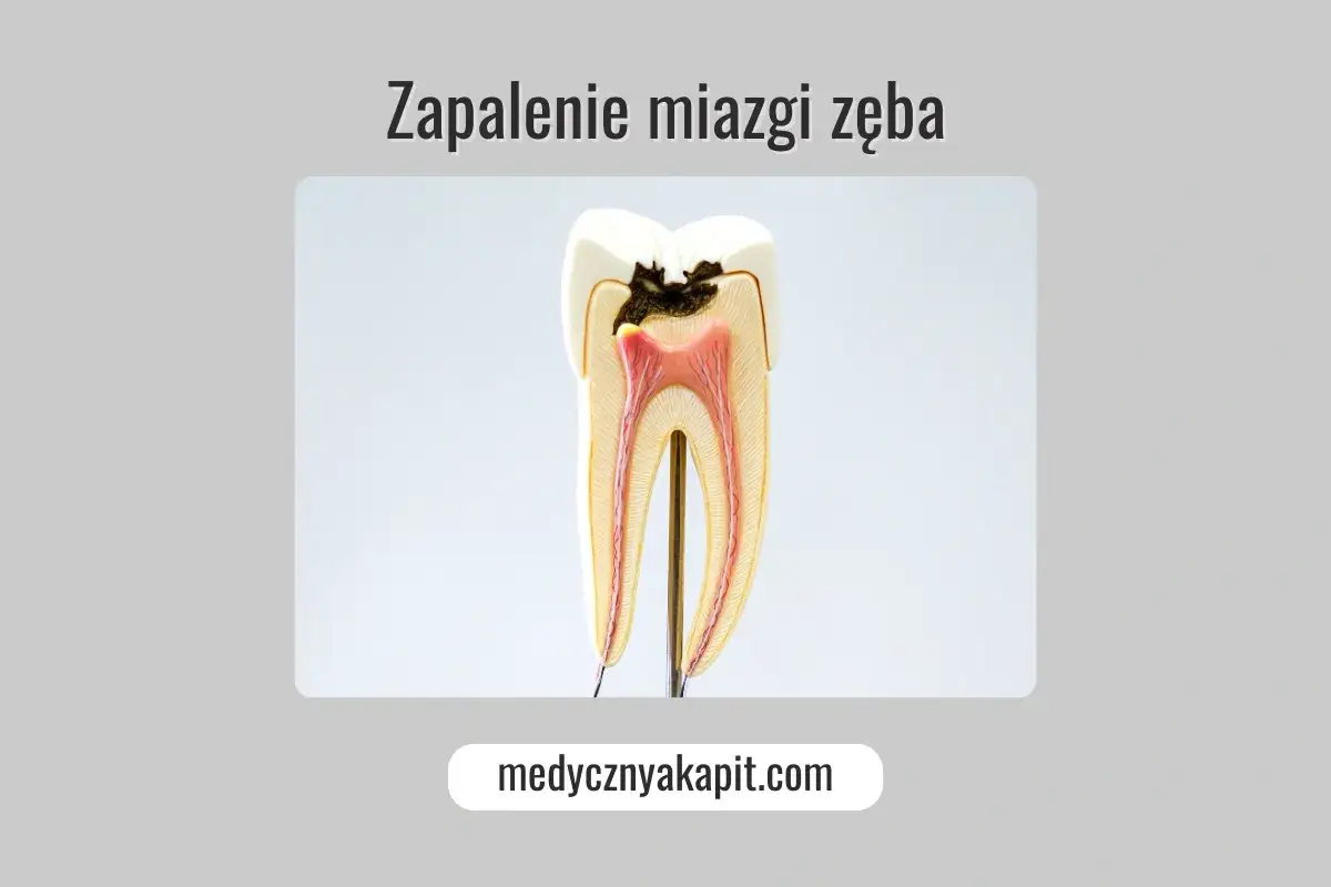 Model zęba ukazujący próchnicę i stan zapalny miazgi zęba.
