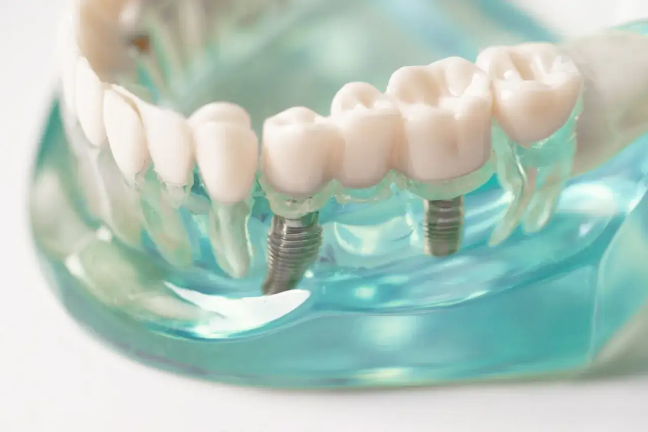 Model szczęki z implantami zębów. Sprawdź, jaka jest implanty zębów cała szczęka cena i odzyskaj piękny uśmiech.