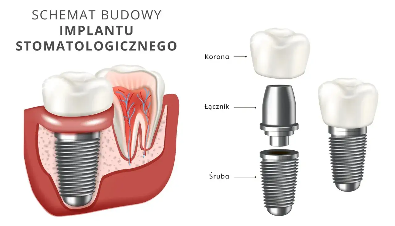 Schemat budowy implantu stomatologicznego: śruba, łącznik i korona. Dowiedz się, ile kosztuje implant zęba 6.