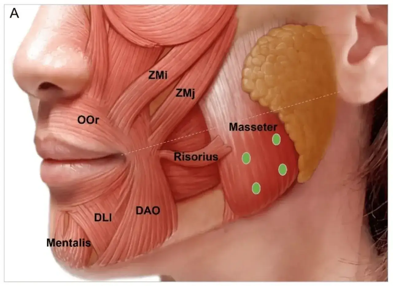 Anatomia mięśni twarzy z zaznaczonymi punktami iniekcji botoksu na bruksizm w mięśniu żwaczu.