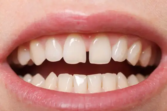 Diastema - kiedy leczyć przerwę między zębami?