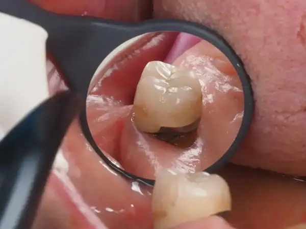 Widok z lusterka dentystycznego na ząb z widoczną koroną kompozytową, która chroni go przed dalszym uszkodzeniem.