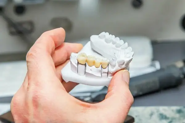 Model szczęki z porcelanowymi zębami, gotowy do cementowania. Sprawdź, jaka jest most adhezyjny cena.